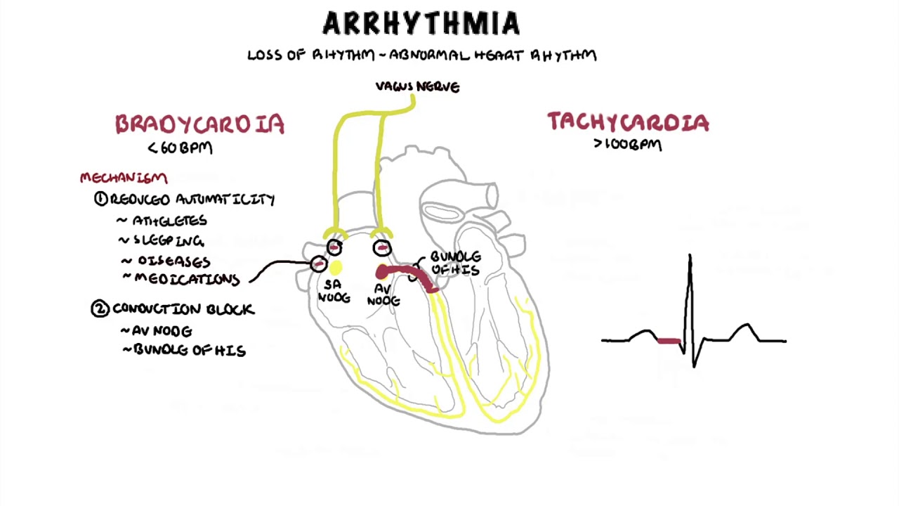 What Are The Signs And Symptoms Of An Arrhythmia?